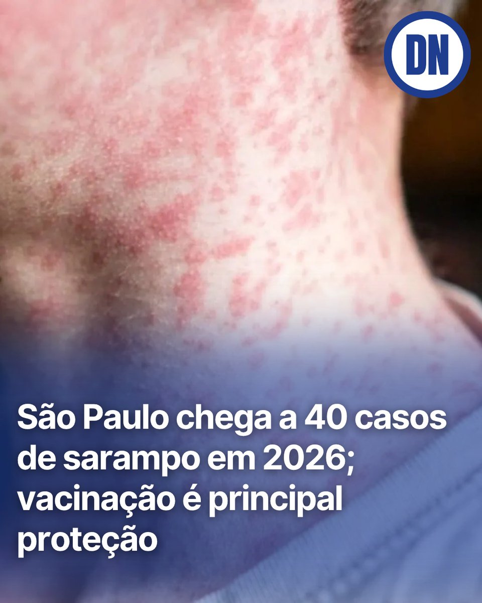 RedacaoDN's tweet photo. Sarampo volta a acender o alerta em São Paulo: o estado chegou a 40 casos confirmados em 2026.

Dos pacientes, 30 não tinham vacinação completa ou registro de imunização. Crianças menores de 2 anos concentram cerca de 60% dos casos.

Saiba mais no Diário de Notícias. Link na bio. https://t.co/8TNqDzw9x6
