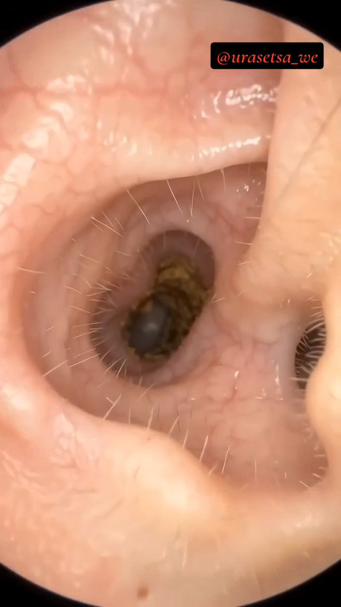 Endoscopic or microscopic medical image showing the inside of a body cavity with a larva visible deep within the passage, watermarked '@urasetsa_we'.