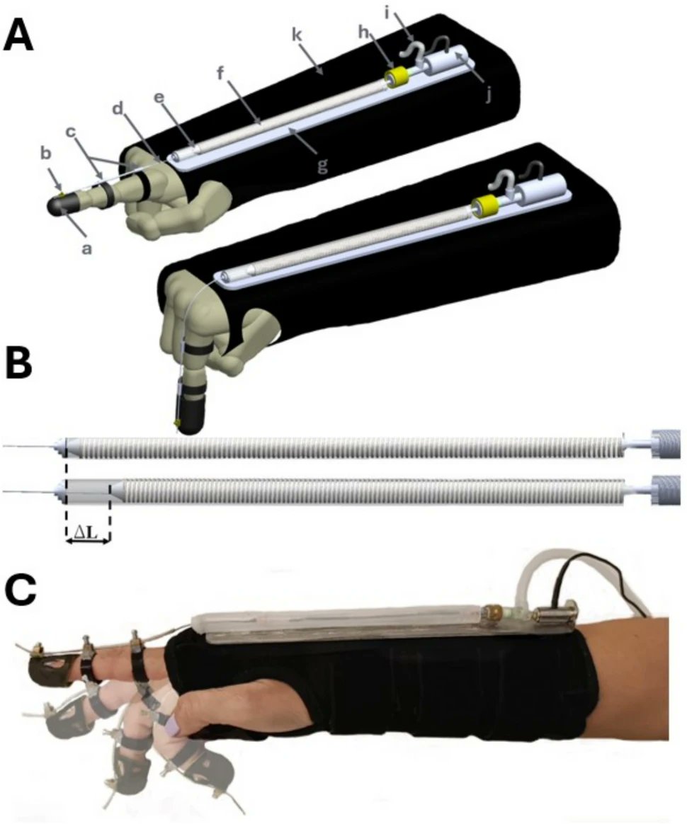 ABMEjournal's tweet photo. Restoring hand function after injury or illness can require carefully controlled resistance during rehabilitation – something conventional splints struggle to provide.

Engineers developed a dynamic hand splint that replaces traditional elastic components with soft pneumatic actuators designed to provide controllable resistance during finger flexion. The prototype uses an actuator mounted on a forearm brace and connected to a finger through a tendon, while an onboard load cell monitors force during movement. Psychophysical testing showed that users could reliably perceive changes in resistance and that increasing actuator pressure reduced the average force on a fully flexed finger from approximately 5.2 newtons to as little as 0.7 newtons.

Actively controlled force could allow hand rehabilitation exercises to respond to changing needs, allowing clinicians to adjust therapeutic demands as recovery progresses.

𝗥𝗲𝗮𝗱 𝗺𝗼𝗿𝗲: https://t.co/bHusMmr9P5

𝗦𝘁𝘂𝗱𝘆: Hand Rehabilitation Dynamic Splint with Variable Force via Pneumatic Artificial Muscle Actuators

𝗔𝘂𝘁𝗵𝗼𝗿𝘀: Valentina Potnik, Gabriele Frediani, Mattia Dimitri, and Federico Carpi

@UNI_FIRENZE

𝗦𝘂𝗯𝗺𝗶𝘁 𝘆𝗼𝘂𝗿 𝗺𝗮𝗻𝘂𝘀𝗰𝗿𝗶𝗽𝘁: https://t.co/Gyz8DNneUg