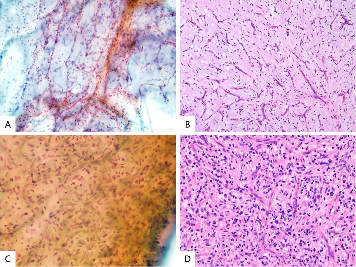 StainsFile's tweet photo. Angiofibroma of soft tissue is a rare benign fibroblastic/myofibroblastic neoplasm.

🔍 This study identified a distinctive cytological features to support accurate diagnosis: vascular patterns within distinct stromal backgrounds.

Learn more: https://t.co/q02geOLf2Z

#Pathology https://t.co/h8bssfI7KV
