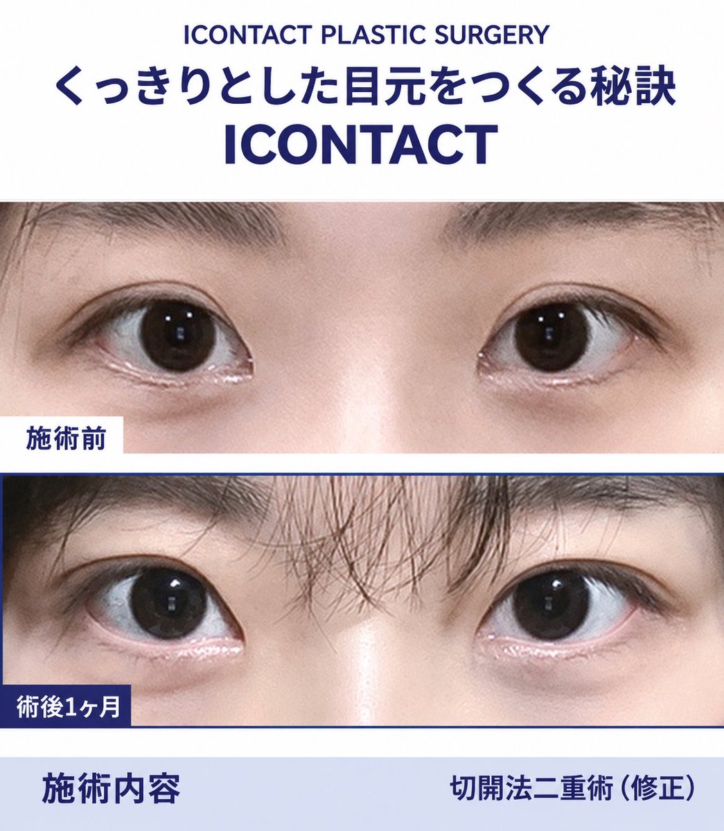 icontactjpps's tweet photo. 目初整形の症例写真👁✨
二重切開再手術

理想の目元を叶える #アイコンタクト整形外科

現在の目元の状態を確認してあなたの目元に似合うラインをお届けいたします🖤

#目専門 #二重修正 #目再手術 https://t.co/Ij7EuPyuCY