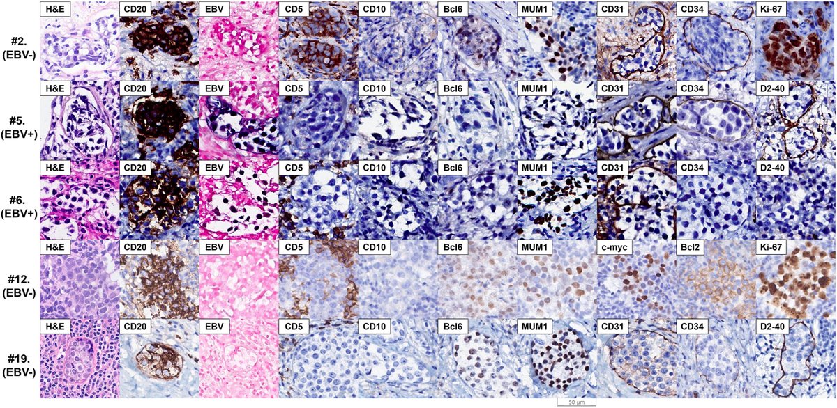 Human_Pathology's tweet photo. New in #HumPathol: Nodal large B-cell lymphoma with intrasinusoidal growth: a clinicopathologic study of a distinctive pattern with diagnostic overlap with intravascular large B-cell lymphoma. https://t.co/mxMWUIa37t #pathology #PathTwitter #PathX #hemepath https://t.co/jjV3Njw4Xr