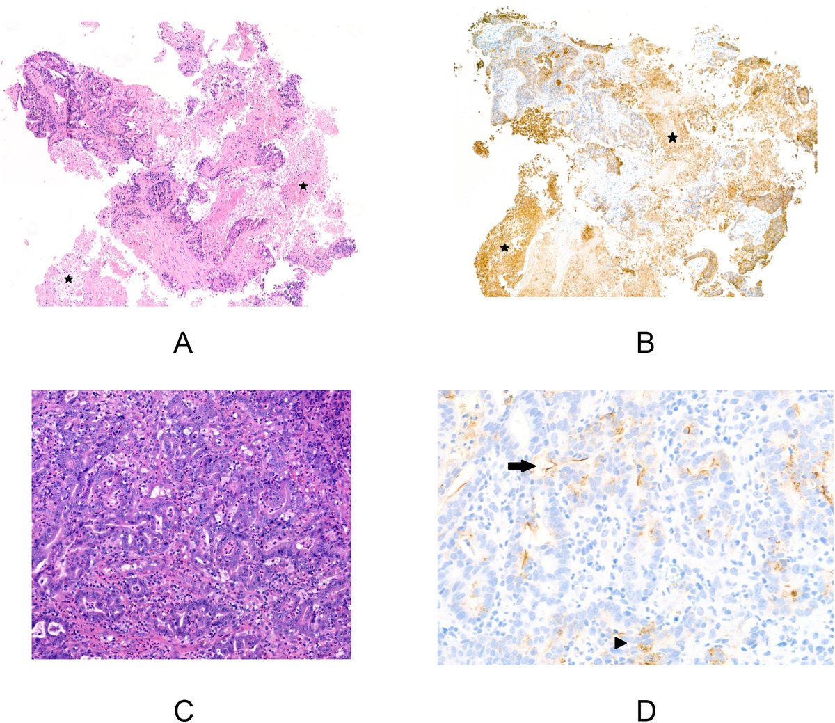 Human_Pathology's tweet photo. New in #HumPathol: Claudin 18.2 Immunohistochemistry in Gastroesophageal Adenocarcinomas: A Study of Interobserver Variability Among Gastrointestinal Pathologists. https://t.co/0FFz96mddB #pathology #PathTwitter #PathX #GIpath https://t.co/O4BNzzp0Kq