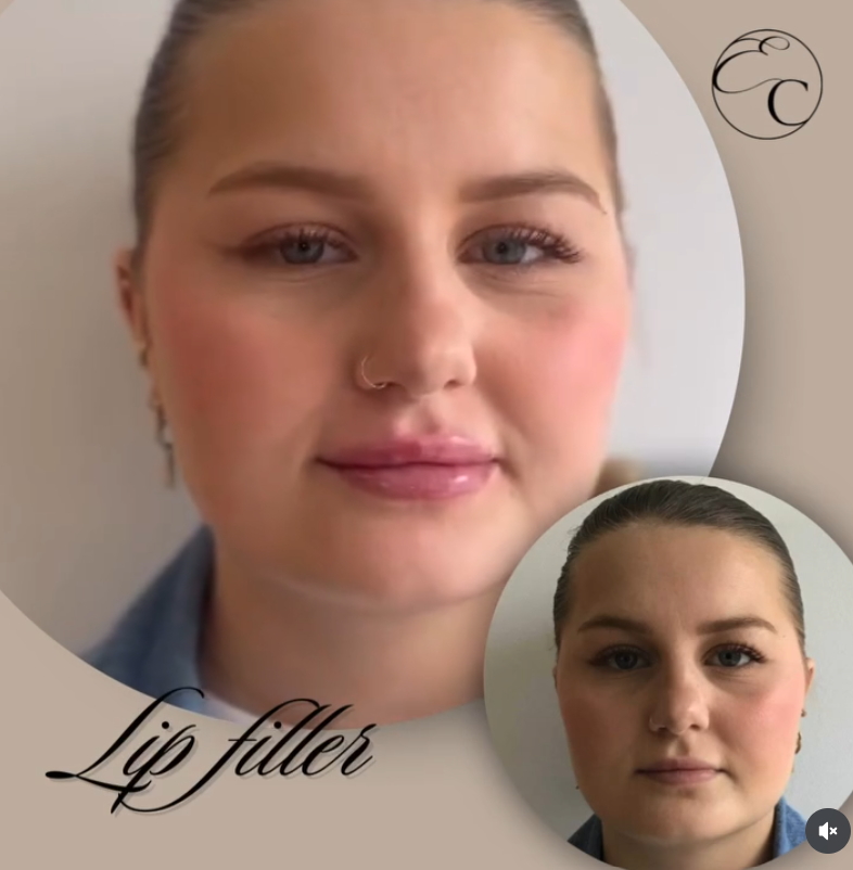 EnhanceClinicBe's tweet photo. 𝐋𝐢𝐩 𝐟𝐢𝐥��𝐞𝐫 👄

1ML Lip filler for this cutie!
Visit: https://t.co/BHmKG0I6So
🕣 Appointment time: 20 min
🤕 Downtime: Bit of swelling and bruising can accur, allow two weeks to fully settle.

#enhanceclinic #aesthetic #ghent #botox #beauty #fillers #skincare #filler https://t.co/FuBJHKQazX