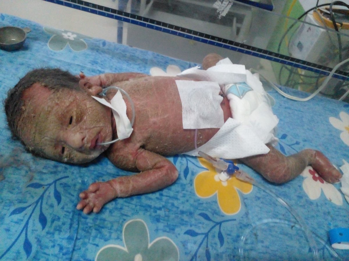 pspkcults__'s tweet photo. #Verified
Newborn battling severe congenital skin peeling syndrome in NICU &amp; in immense pain. This is the 4th baby in our family affected by this rare condition. Please help save the child with any small contribution!

​UPI ID: adityaga12@axl

​Please Amplify 🙏
@Nandamurifans https://t.co/Ihp7QmJvSL