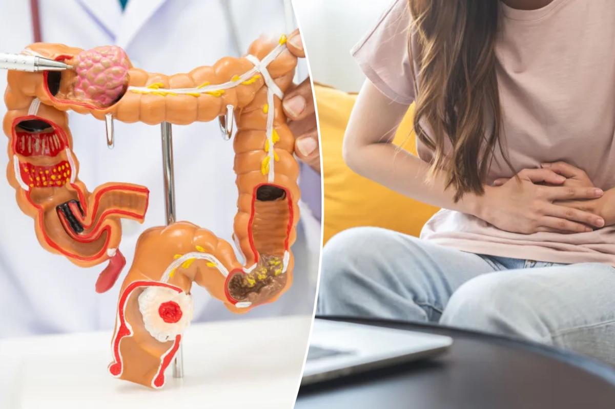 nypost's tweet photo. Colorectal cancer rates are rising among teens, new study finds - the 4 most common symptoms https://t.co/xvbpYSojA9 https://t.co/vcCFcw4anz