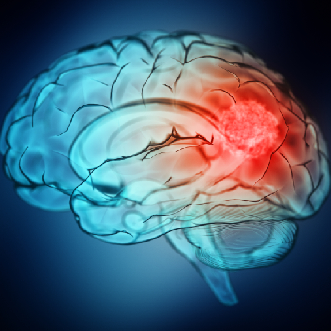 DukeCancer's tweet photo. A new study mapped immune cells within brain metastases and found specific macrophage populations associated with patient survival. The findings may help guide future treatments for metastatic cancer. Learn more by clicking link in bio.

https://t.co/NJN0K41hot #macrophage https://t.co/LYmeRDInet