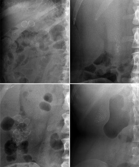 RadMasterclass's tweet photo. ABDOMINAL X-RAY 17: 4 different patients. What are the abnormal foci of calcification? Answer https://t.co/UuXEtGoFFv https://t.co/JpIPXtZZ0E