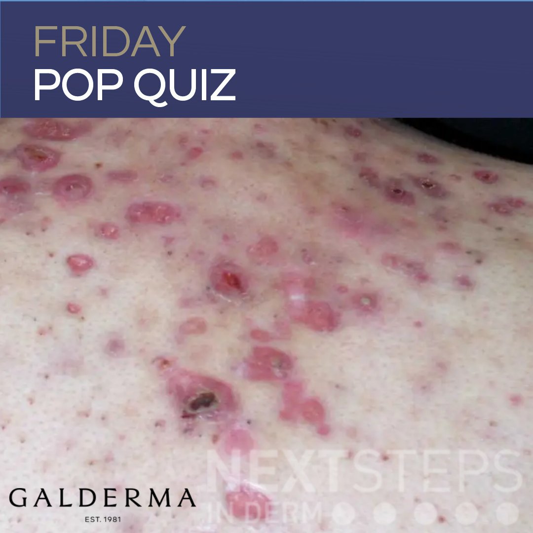 DermInReview's tweet photo. New Friday Pop Quiz alert, brought to you by Galderma! 

Test your derm board knowledge: drop your best guess in the replies below, then head over to Next Steps in Derm to check the answer and full explanations! 👇

https://t.co/AdTX0ws2HP

#Dermatology #MedEd https://t.co/WmTSWleyDy