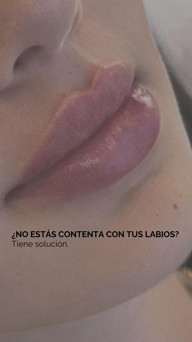 420xNO2's tweet photo. Not happy with your lips? There’s a solution. Hyaluronidase dissolves hyaluronic acid when results aren’t as expected, correcting excess volume or asymmetry. At Blarsi, we assess each case to restore a natural, balanced base. https://t.co/TxpgLZFQx0