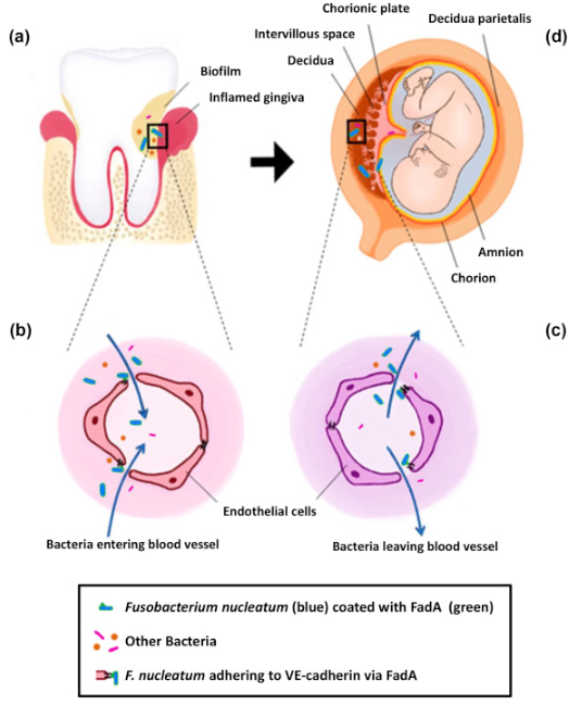 DrGrahamLJ's tweet photo. Q. How do gum disease bacteria cause pregnancy complications?

A. They escape the mouth via the bloodstream and damage placental/umbilical/foetal blood vessels.

(How long will it be before we get what this means?)

👇👇👇
Vander Haar 2018
https://t.co/41YeBUDiDh https://t.co/nAPoxTFrG8