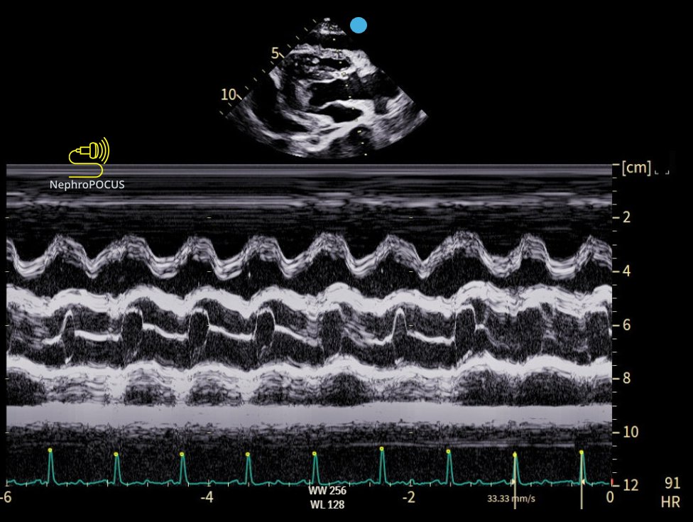 NephroP's tweet photo. #POCUS classic!
#Nephpearls #FOAMed https://t.co/LsdXnvYIPf