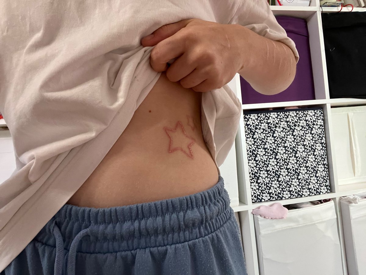 Mybigaaahballs's tweet photo. @microdxse I also have a star scarification!! Tho your lines look much cleaner than mine https://t.co/ROnvlM3tBH