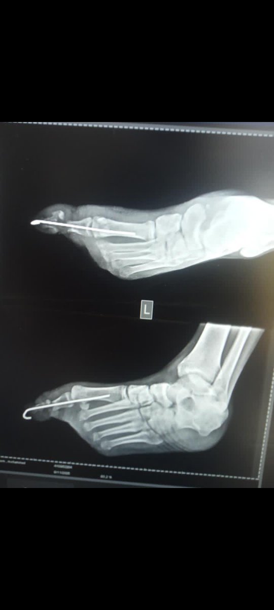 IAlqrem's tweet photo. My brothers, there have been no donations for a long time. My father needs treatment and is suffering greatly. Please share and donate; it's very urgent.Even my amputated leg needs treatment https://t.co/ngAI7wZUxq
 @meralhece @ElizabethMaritz @Oliv_1299 https://t.co/2falzkOgdT