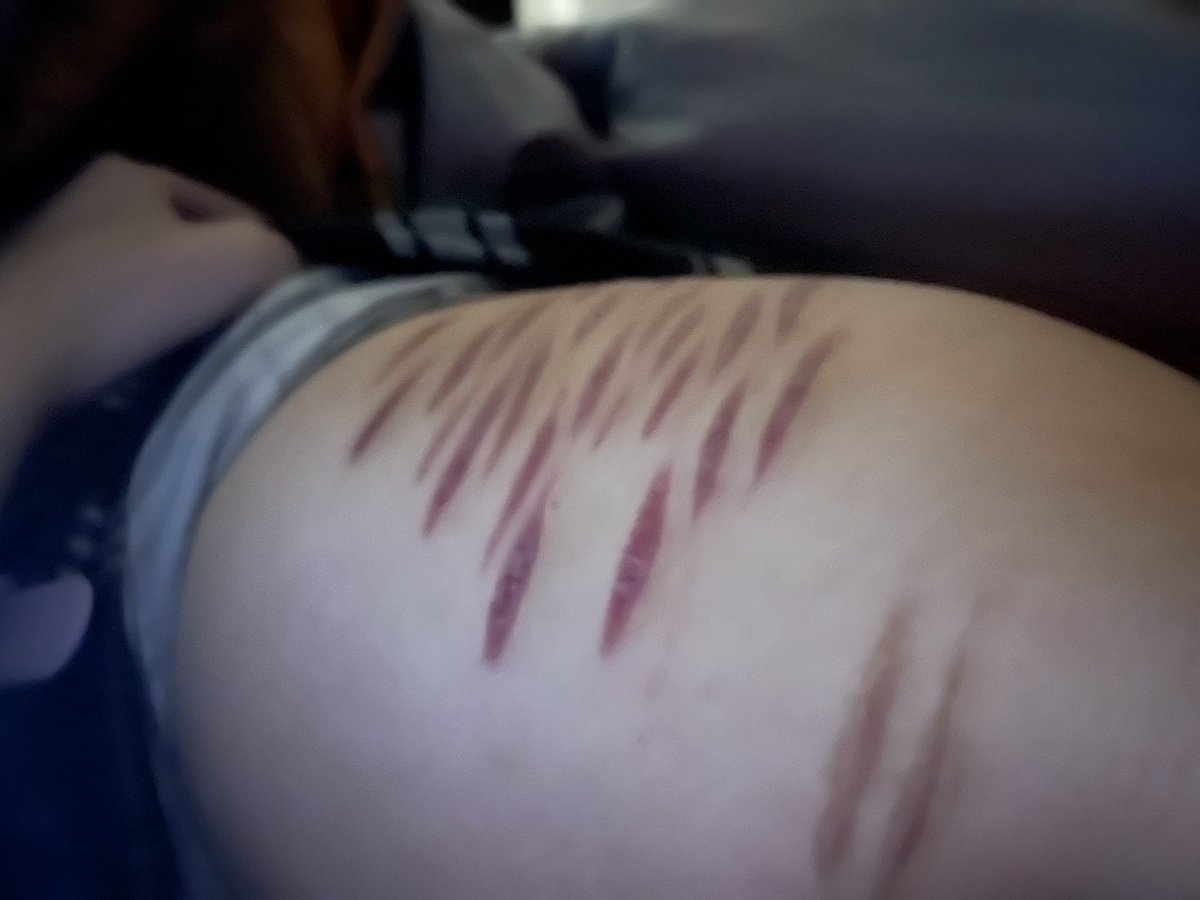 dtjcli's tweet photo. This is how my scars look like now if anybody’s wondering. They became darker, sometimes turn bright pink and sometimes turn very dark purple.

Ai generated photos
#shtwt #shramtwt #sfwmakeup #fake https://t.co/JFS8qNUfTa