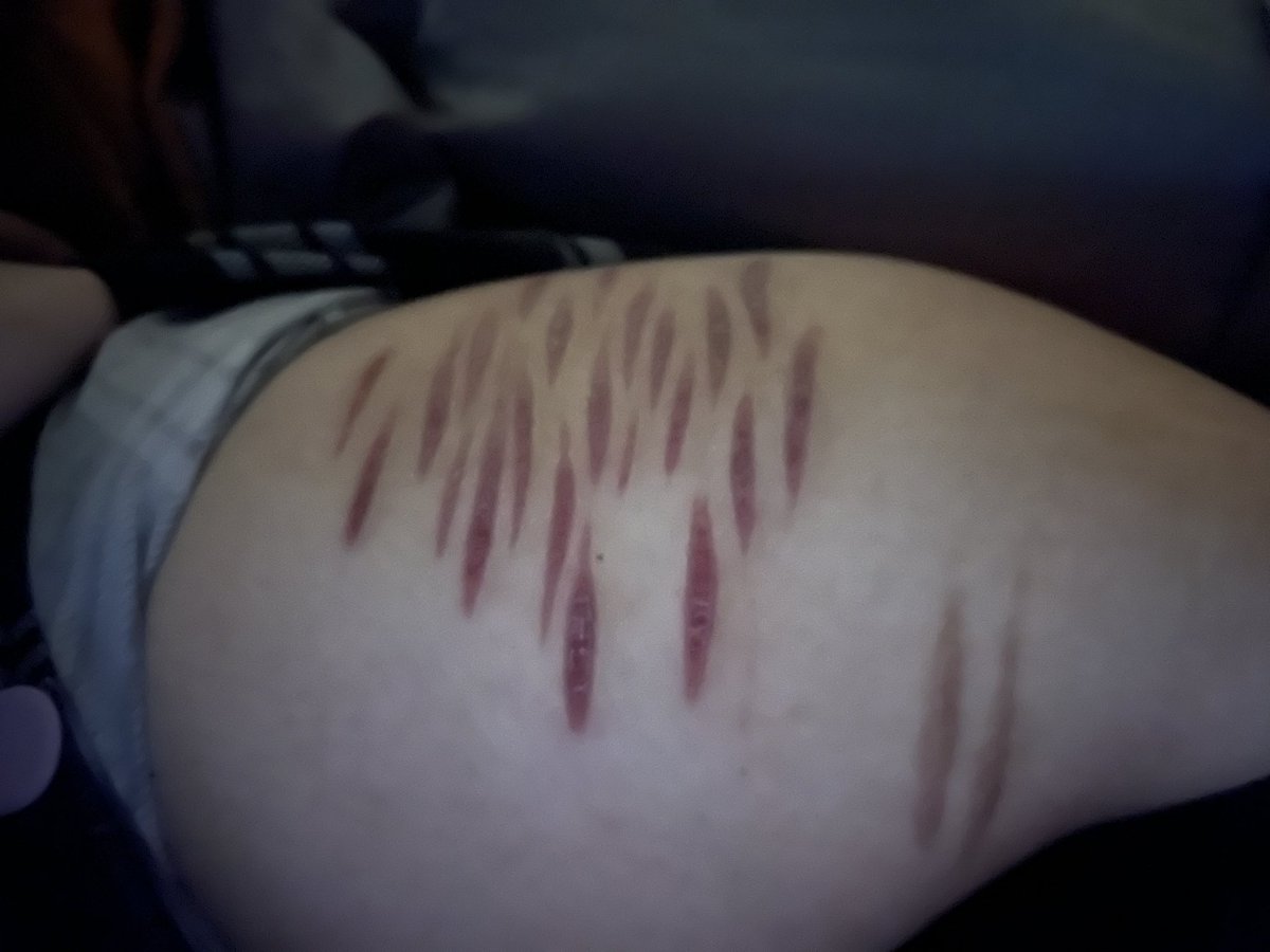 dtjcli's tweet photo. This is how my scars look like now if anybody’s wondering. They became darker, sometimes turn bright pink and sometimes turn very dark purple.

Ai generated photos
#shtwt #shramtwt #sfwmakeup #fake https://t.co/JFS8qNUfTa