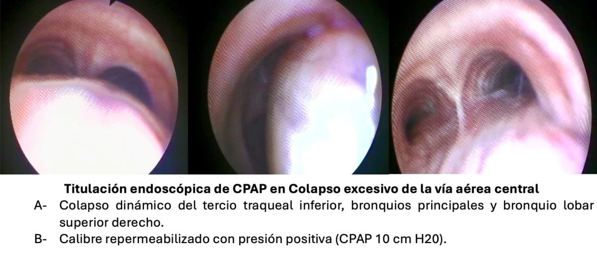 IPSParaguay's tweet photo. 🤝 El Hospital Central fortalece su Sección de Neumología Intervencionista con broncoscopías de alta complejidad en internación y UTI. Incorporamos al Dr. Ezequiel Morínigo, Fellow ALAT con formación en EE.UU., España, México y Argentina.
🔗 Leer más: https://t.co/VX8ws6JrWQ https://t.co/cPAySUf6Oh