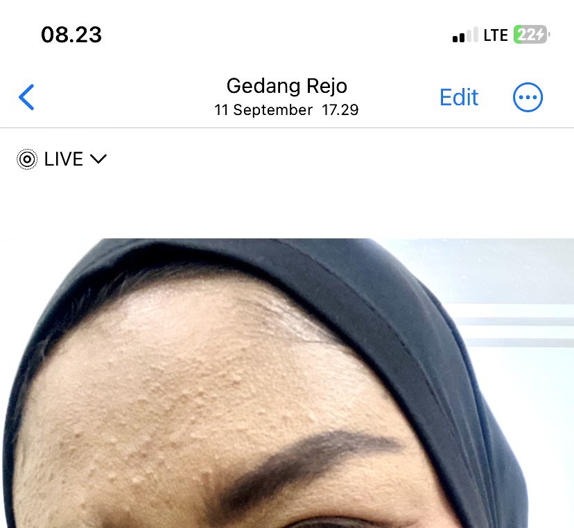 dittazharra's tweet photo. salah satu holy grailku buat atasi bruntusanku kemaren adalah serum exfo. 
makasih banget, meskipun gak instan tapi progresnya ada 😭￼ https://t.co/x7dkOONs9S