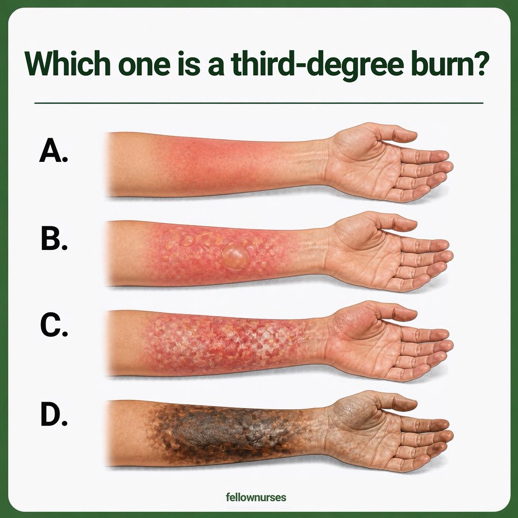 FellowNurses1's tweet photo. Comment your answer below (A, B, C, or D) and tag a nursing student or colleague who needs to see this!

#NursingEducation #MedStudent #BurnCare #ClinicalSkills #NurseLife #NursingStudents #EmergencyNursing https://t.co/F73mzTdFjg