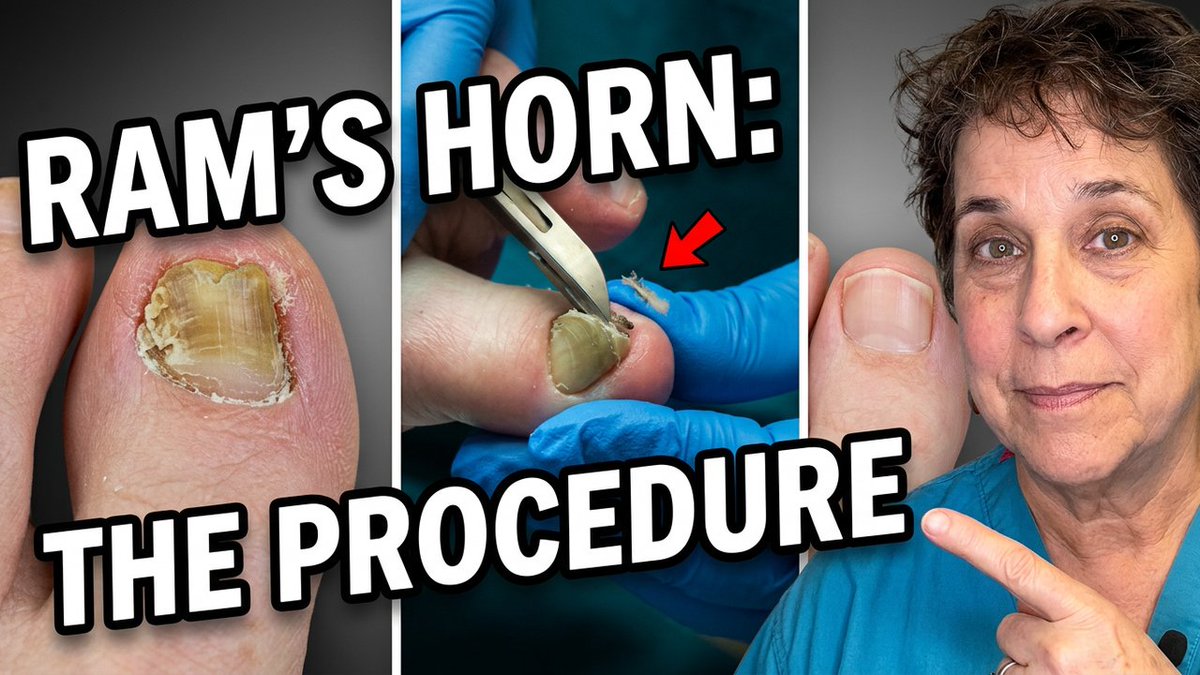 drnailnipper's tweet photo. FEET-ure Friday today at 4:00pm ET

FEET-ure Friday | Rams Horn Toenail - She Hid This Toenail for Years… Then a Podiatrist Fixed It  -- https://t.co/eoUcrrVHYe

@MiamiRadioBeast @PodiatryToday https://t.co/FmT9rgEcGz