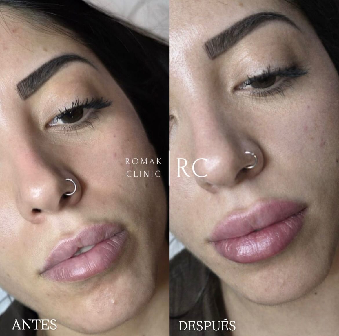 420xNO2's tweet photo. Photo by Romak Clinic | Aesthetic Medicine, Nutrition and Psychology Clinic at Romak Clinic with @dr. ronymaksoud. https://t.co/333YSWf4xt
