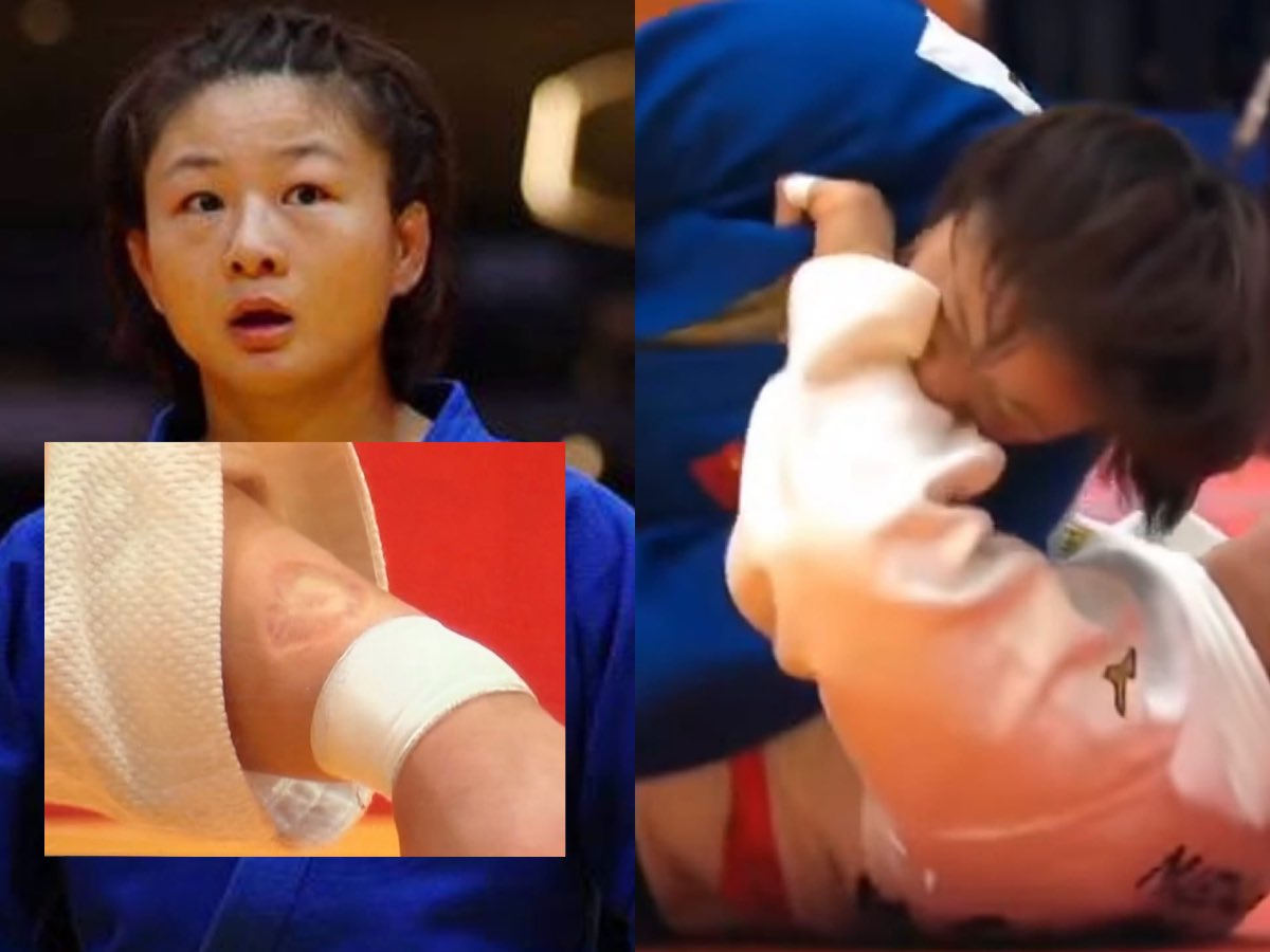 TheKhelIndia's tweet photo. The bite marks left by Chinese judoka Tang Jing  🇨🇳on Japan’s Rin Maeda 🇯🇵

Despite the shocking incident, Maeda went on to win the Asian Games Gold Medal! 🥇

Tang Jing was disqualified after the incident.

Such conduct should have consequences. Actions need to be taken!!!! https://t.co/WNspKbH7yM