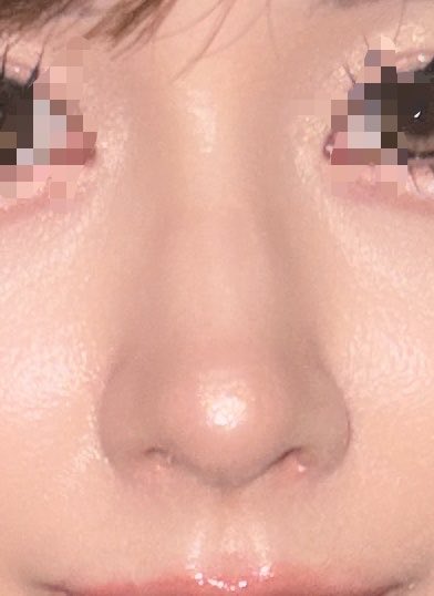 鼻フルもうすぐ2ヶ月だよ⭐️
忘れ鼻に近づいたお陰で目がでかくなったって言われるようになったよ⭐️
もう少し鼻先シュってしてほしい🥹 https://t.co/7rIMKs1c87