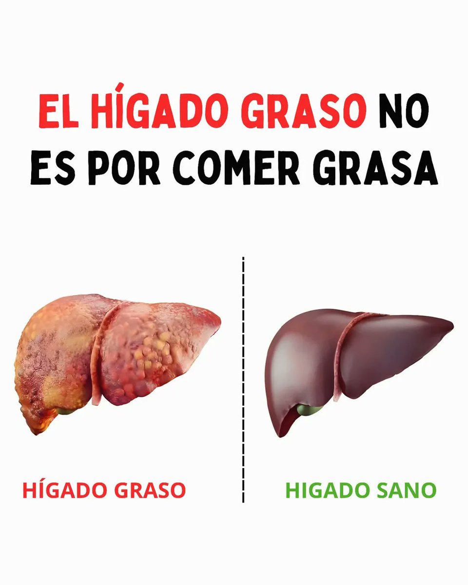 VirtudMental's tweet photo. ¿QUE OCASIONA EL HIGADO GRASO?

--Hilo-- https://t.co/8dfwSCJNYM