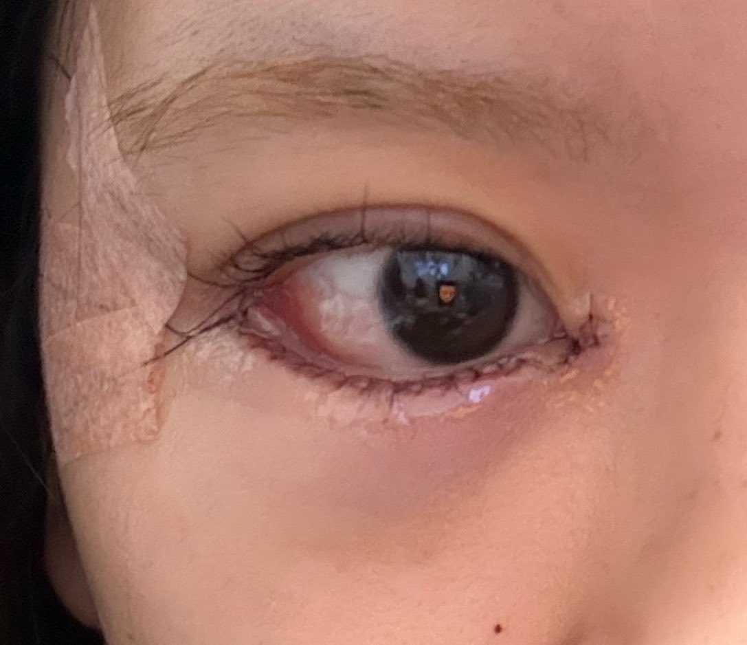 mgmgdame's tweet photo. 目尻目頭切開、タレ目形成ダウンタイム中です！情報交換できる方良ければ繋がってください🤍
#整形垢さんと繋がりたい https://t.co/uYui82FQWe