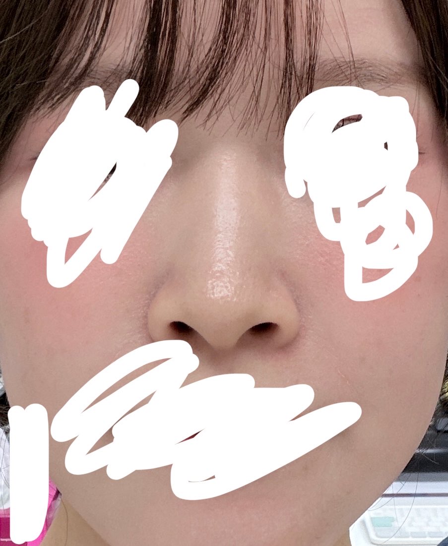 runrunrun__k's tweet photo. 両顎でこのくらい鼻変わったよ
鼻の穴見えすぎる
⬅️Before                 ➡️After https://t.co/NuJ1DO7Z6x