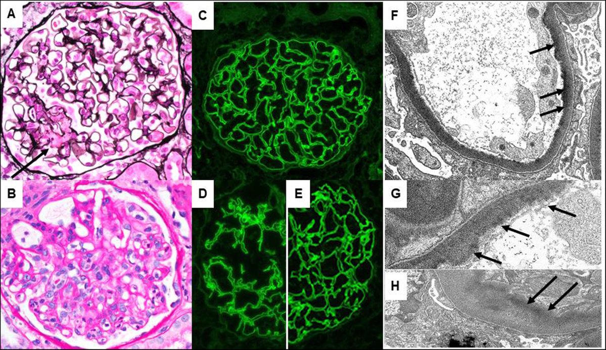 roboonya's tweet photo. Anti-GBM nephritis in transplant kidney of 31 yo Alport patient. Unusual LCDD-like deposits detected in glomeruli https://t.co/EOE8lzYc80 https://t.co/hXnzHzCSxP