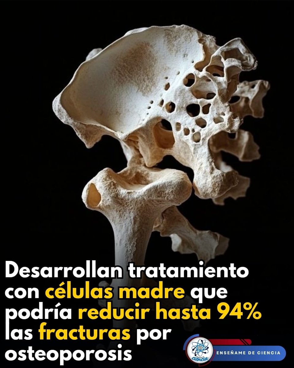 EnsedeCiencia's tweet photo. ℹ️ En un primer ensayo clínico, los expertos dieron a conocer que se logró reducir hasta un 94% las fracturas en diez mujeres que llevaron seguimiento durante seis años. Y aunque la investigación todavía es preliminar, los científicos están trabajando en un estudio de mayor tamaño.