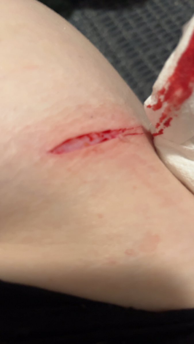 Somebitch_101's tweet photo. I’ve been clean for like a year I just relapsed but I don’t fucking know why. I haven’t felt much recently except for happy. I’m not even homesick yet. This was so random. What the fuck is wrong with me why can I not just fucking move on. I don’t fucking understand. https://t.co/qgHwjgR7sj