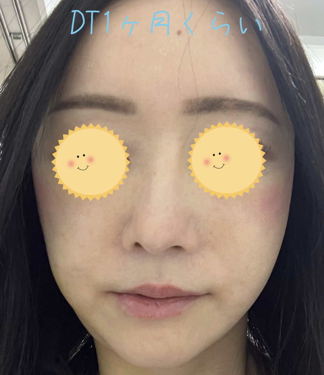 mmm_rin391's tweet photo. 完成度で満足される方いないのでは。費用が安ければ、安かろう悪かろうで納得も出来ますが、この仕上がりに100万以上かける価値無いと思いません？セミンは価格と先生の技術力が伴ってないと感じました🤷‍♀️
#セミン整形外科　#切開リフト https://t.co/eiMauQA6dC