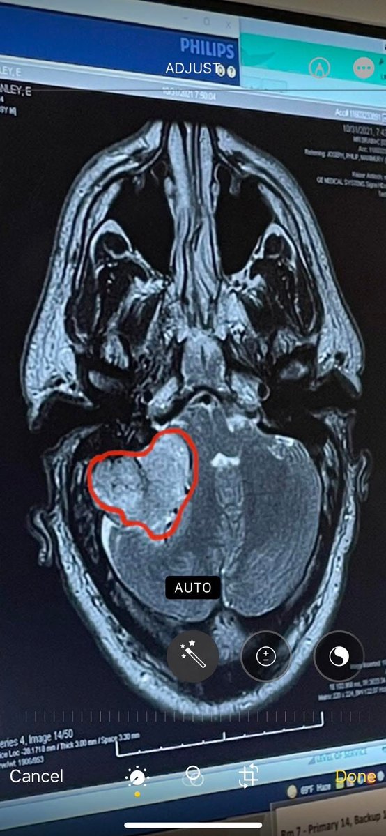 stancox6's tweet photo. @KidRock Had a brain tumor the size of a lime! 11 hour surgery, 35 days strait radiation appointments. Prayed, &amp; stuck to the plan, never giving up hope &amp;kicking this disruption in its ass. Positivity &amp; family is a drug they can’t  prescribe, but U got both! U got this bro! #6yrsNoCancer https://t.co/RPjcOoeMcY