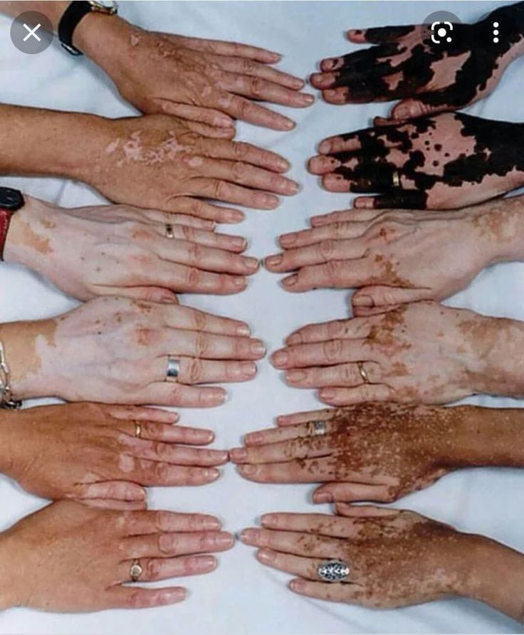 esme_essie_'s tweet photo. If your skin changed overnight, would the love you have for yourself still feel the same like it was never really about the color at all?Be honest. https://t.co/8WJVpZQ5Z1