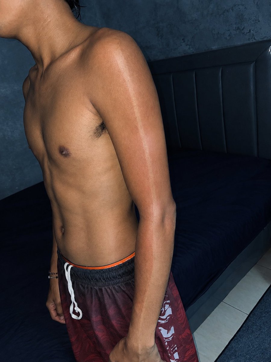 5goonex's tweet photo. Kwkwkw sunburn is real 🌞 after  bersihin bekas henna tattoo.

#medan #sunburn https://t.co/ELqaj6NItm