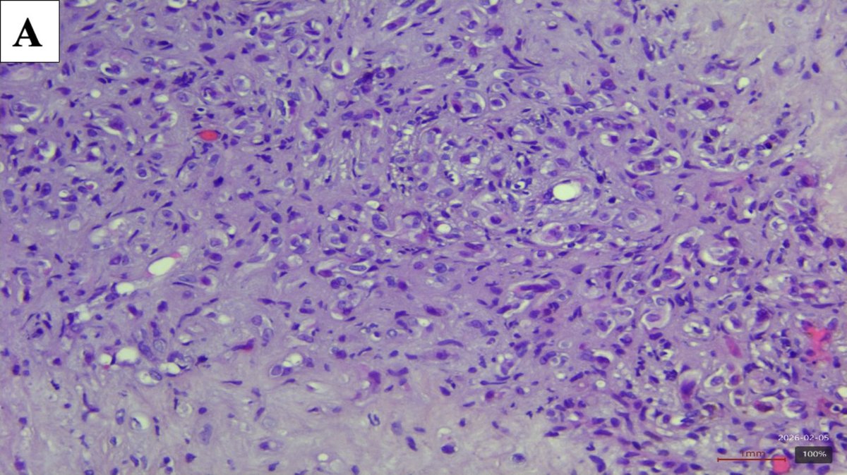 jppathpd's tweet photo. Dx? liver CD34 #pathkeys https://t.co/tijxUT1SuX