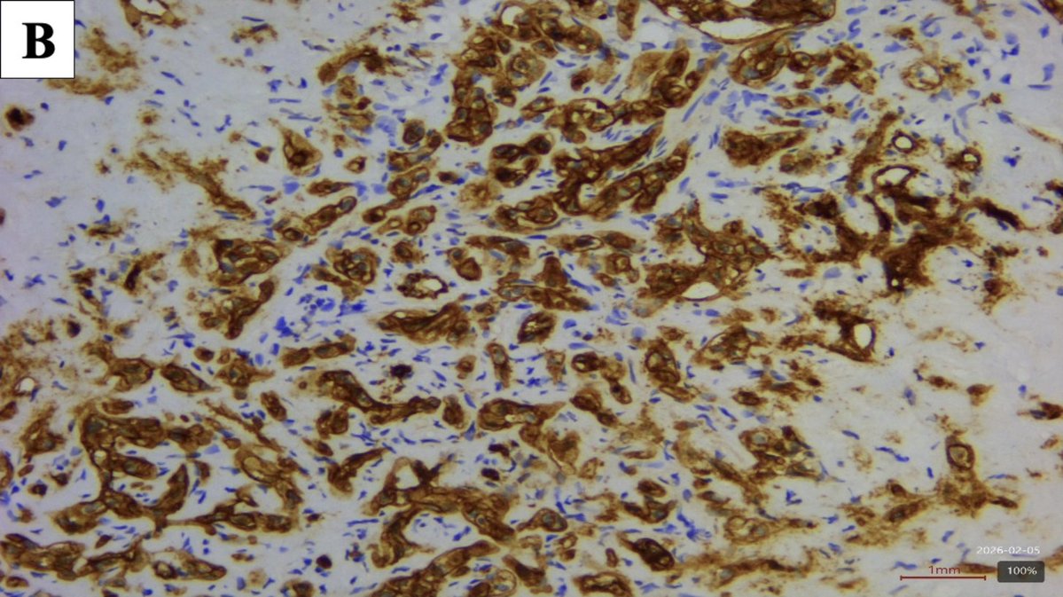 jppathpd's tweet photo. Dx? liver CD34 #pathkeys https://t.co/tijxUT1SuX