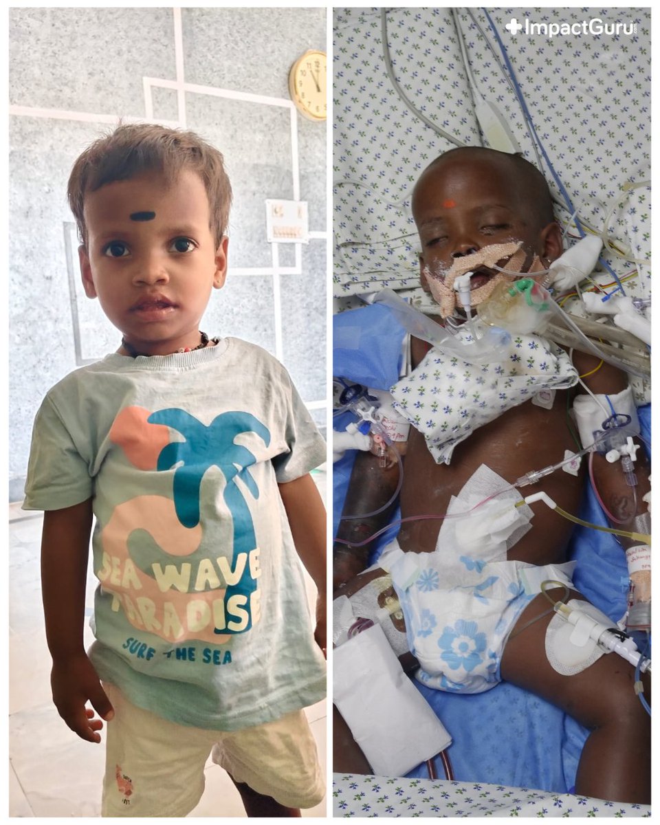 ImpactGuru's tweet photo. 2-year-old Jaydeep is in the PICU on a ventilator, battling severe dengue with liver, lung and kidney complications. He needs ongoing dialysis and critical care.
Help this little boy come home. Donate now: https://t.co/FOrzcr1p1e
#SaveALife #RaiseFunds https://t.co/sb1Y0le1GV