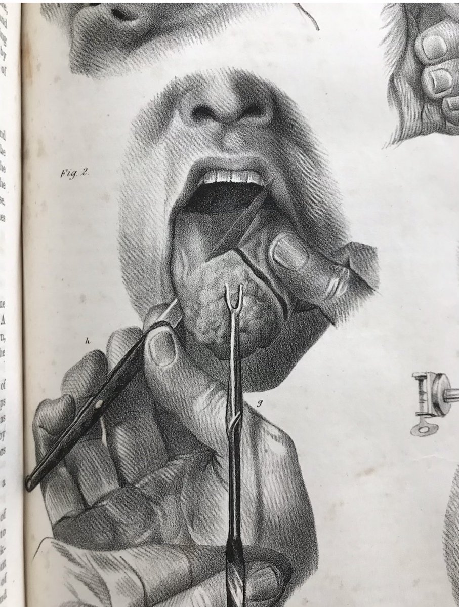 patricksrarebks's tweet photo. Another engraving from Pancoast’s Operative Surgery, 1844. Every surgeon should own a copy. https://t.co/towDxHL2zI