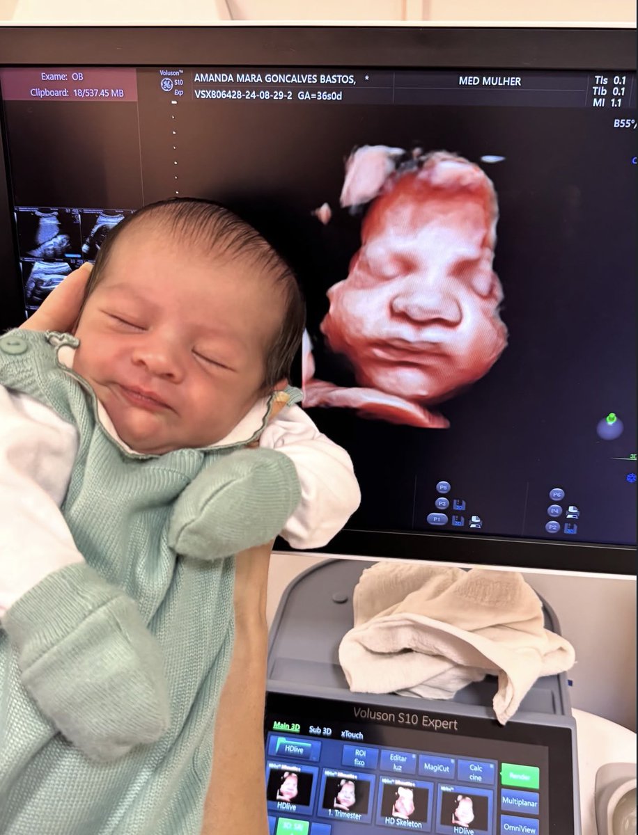 metrofive5's tweet photo. Is there anything more exciting than seeing a baby’s face on an ultrasound and then months later seeing that exact same face after birth? 🥹❤️ https://t.co/4NRAP88wQp