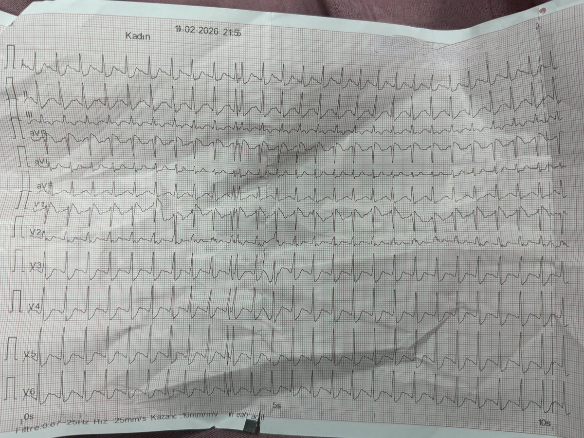remzi_sarikaya's tweet photo. Genç hasta, arrest ->20 dakika CPR sonrası çekilen EKG 
Yakın süreçte diz operasyon öyküsü var. 

EKG ye bakarak ne söyleyebilirsiniz ? https://t.co/KgKxiII32m