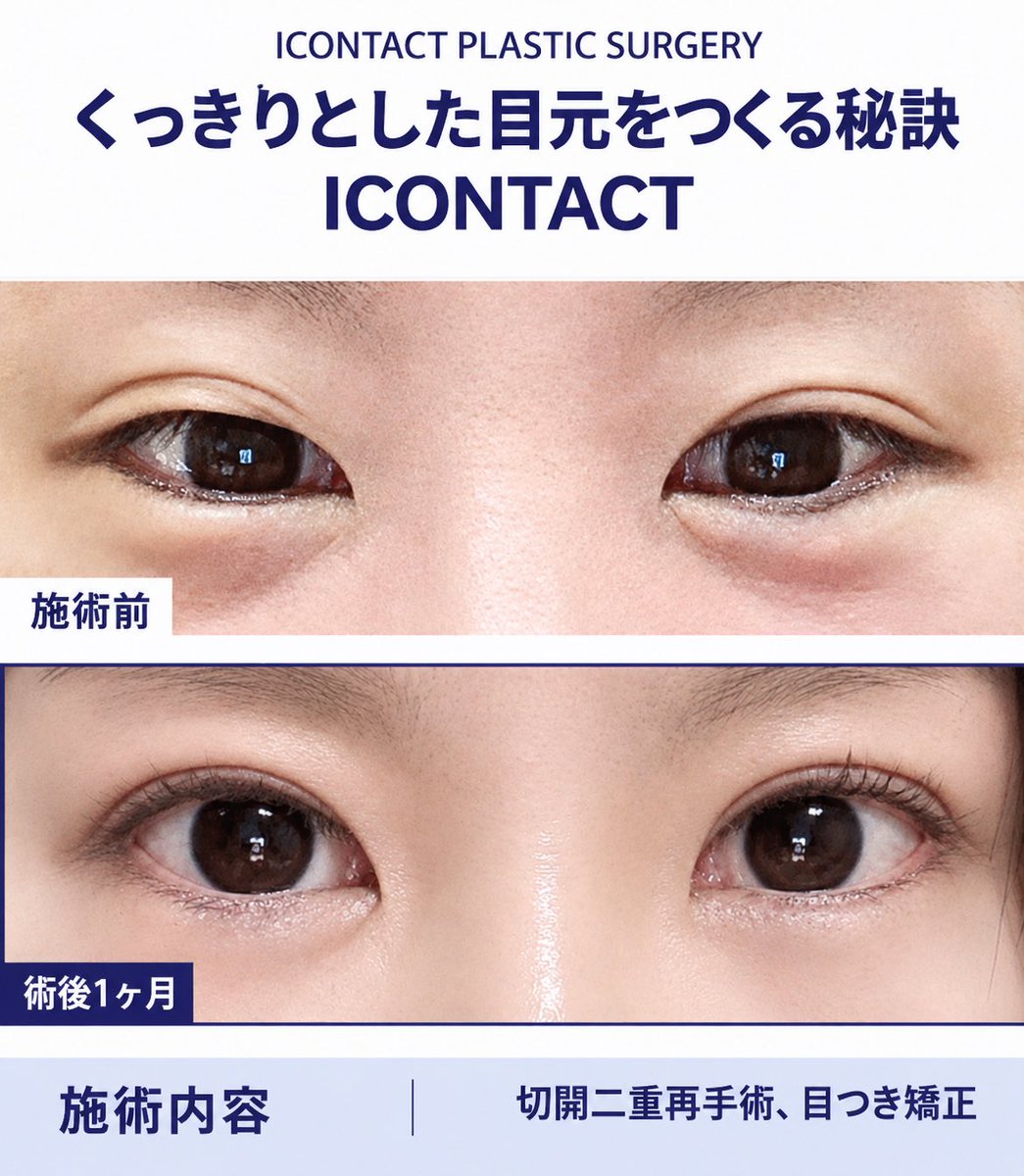 icontactjpps's tweet photo. 目初整形の症例写真👁✨
二重切開再手術＋目つき矯正

理想の目元を叶える #アイコンタクト整形外科

二重が取れて非対称になってしまったラインは再度しっかりとラインを作り直すことでなりたい目元へと🖤

#目専門 #アイコンタクト整形外��� 
#二重修正 #目再手術 #韓国目整形 https://t.co/PN4325ylt0