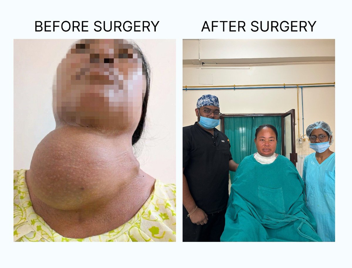 TheAshokSinghal's tweet photo. 26 years of suffering, healed through surgical excellence at TMCH! 🏥

Tezpur Medical College & Hospital has successfully operated on its largest giant multinodular goitre case to date, involving a 43-year-old woman who had lived with progressive neck swelling for nearly 26 years.

The nearly six-hour-long thyroid surgery, performed on 1 October by the Department of Otorhinolaryngology & Head and Neck Surgery, represents another important step forward in TMCH’s capacity to manage complex surgical cases.

The procedure was led by Prof. (Dr.) Rupam Borgohain, supported by Dr. Musukha Narzary, Dr. Monjita Borthakur, Dr. Saiyada Nargis Sultana, Dr. Karishma Ali, Dr. Mangalik Mukherjee, Dr. Tondon Chanu and Dr. Reshmi Roy, with anaesthetic support from Dr. Tapan Kr. Talukdar, Dr. Madhusmita Urang and Dr. Popy Borah.

My heartfelt congratulations to the entire team. Their clinical expertise, meticulous teamwork and unwavering commitment have once again demonstrated the growing strength of specialised surgical care at TMCH. Keep up the good work!

@JPNadda
@MoHFW_INDIA
@himantabiswa 
@CMOfficeAssam 
@mch_tezpur
