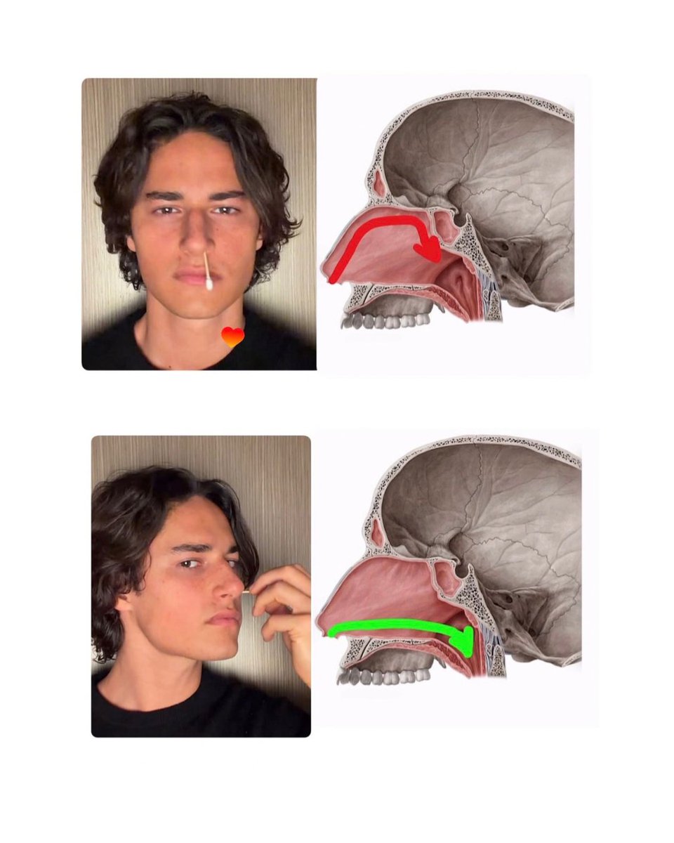OscarPatel's tweet photo. Our palates are narrowing, our faces are getting longer and our jaws are receding

And it traces back to something we do 20,000 times a day without thinking

Breathing.

Not just mouth breathing, but also breathing in the WRONG DIRECTION.

Let me explain:

Air is meant to travel backwards through the nose and into the face, yet most people pull it upwards towards the forehead

When you breathe backwards, your:

→ Back ribs open
→ Diaphragm descends
→ Neck muscles switch off
→ Thoracic fascia glides freely
→ Cervical fascia releases its grip
→ Cranial base begins to decompress
→ Tongue suctions to the roof of the mouth
→ Nervous system shifts into parasympathetic

It is all connected

The nasal turbinates (the filters inside your nose) sit horizontally, so backward breathing filters the air properly, raises nitric oxide and improves oxygen delivery

Multiply that by millions of breaths over the years and it shapes your posture, your digestion, your health and your face

I fixed my sleep disordered breathing, chronic asthma, narrow palate, recessed jaw, forward head posture and knock knees this way

Then my 59 year old mum and my 26 year old sister did the same

Try breathing backwards consistently and let me know how you feel!

Health IS Looks ⚡️