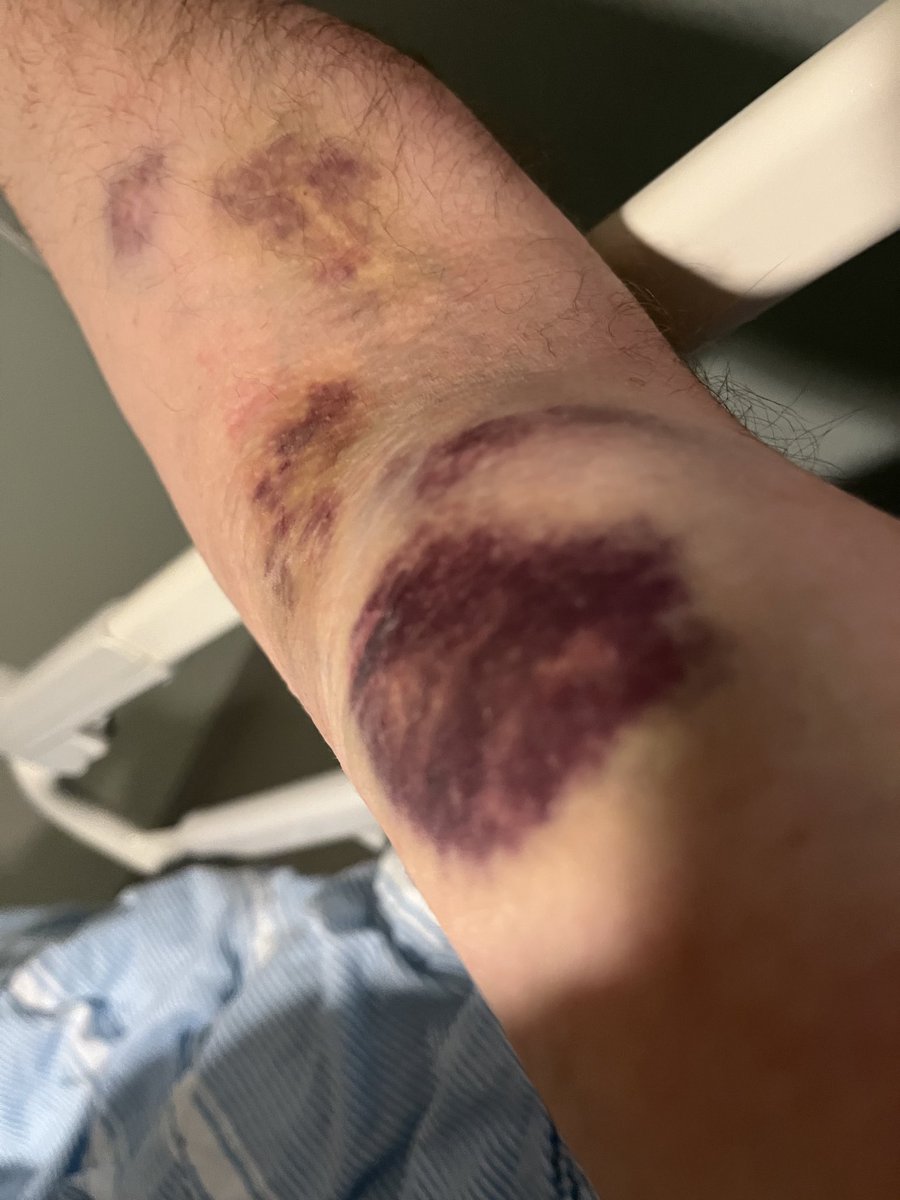 kokodrillo's tweet photo. Angående hon som skulle avrättas med sprutor. Såhär blev det när jag skulle få dropp. Fick det muskulärt inte i ådern. Det gjorde djävulskt ont☠️☠️. https://t.co/JRMKIZ5g01