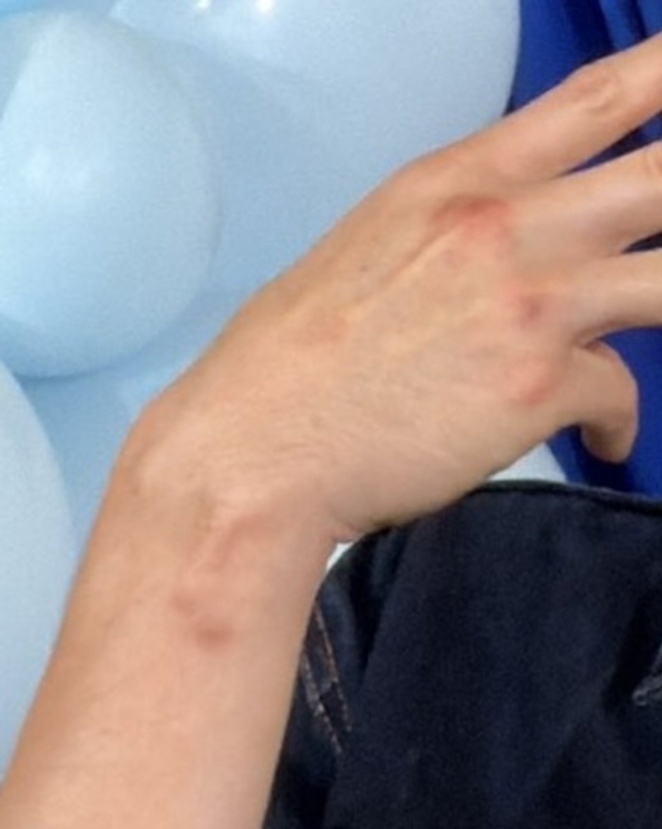 ladyheronstairs's tweet photo. ? ☹️

this is giving me flashbacks to his LOL wounds 🥺 https://t.co/jC3oFdu9hI