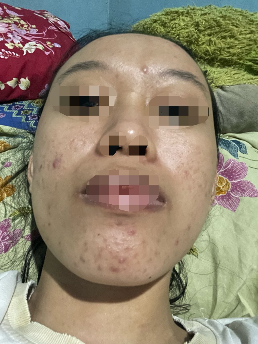 Holla_hop's tweet photo. Saran dong kakak2 ini harus pake produk apa?  Kulitku kering trs pori besar sama komedo. Pake fc you, moist you sama ss wardah ijo spf 50. https://t.co/hiEXXO3c6Q