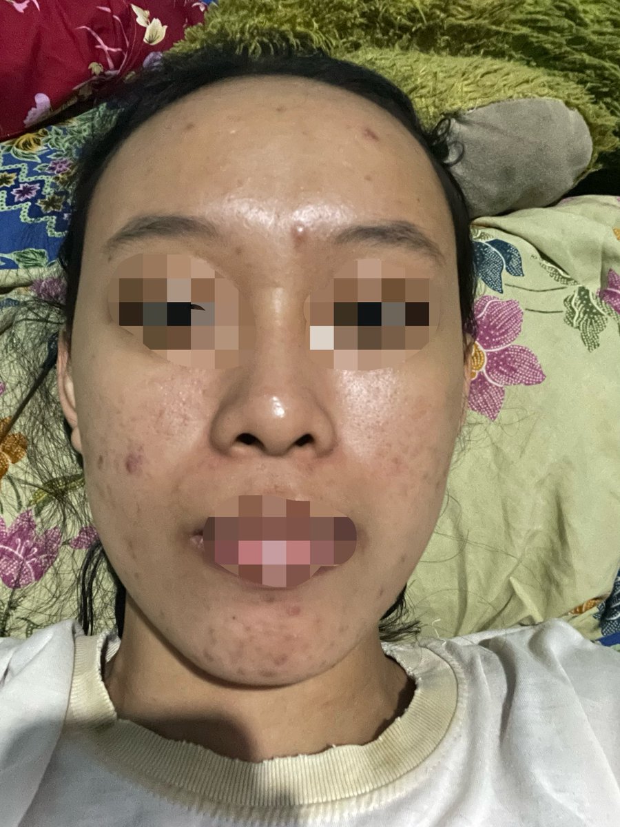 Holla_hop's tweet photo. Saran dong kakak2 ini harus pake produk apa?  Kulitku kering trs pori besar sama komedo. Pake fc you, moist you sama ss wardah ijo spf 50. https://t.co/hiEXXO3c6Q